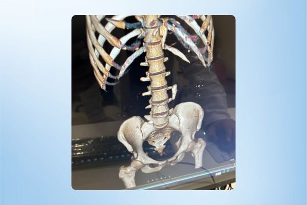 Giant Ureteric Stone Removal