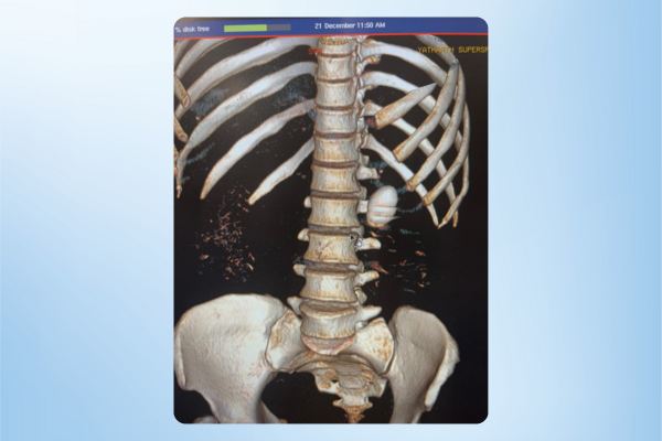 Complex Ureteric Stone Cleared