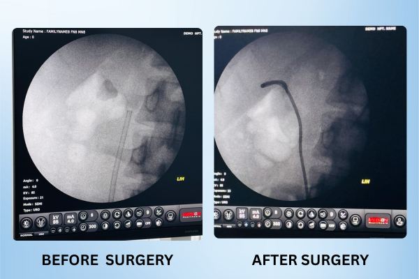 Kidney Stone Removed with Laser RIRS – No Cuts, No Pain